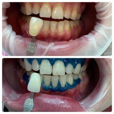 Улыбайтесь чаще! Стоматология «SMILE FOR YOU» дарит скидку до 40%