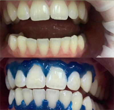 Улыбайтесь чаще! Стоматология «SMILE FOR YOU» дарит скидку до 40%