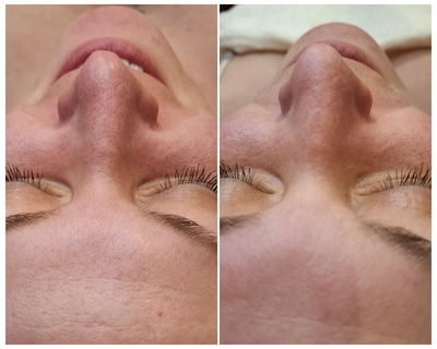 «Lady in Red»: косметологические процедуры со скидкой до 52%