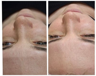 «Lady in Red»: косметологические процедуры со скидкой до 52%